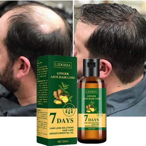 Hair Loss Solution .